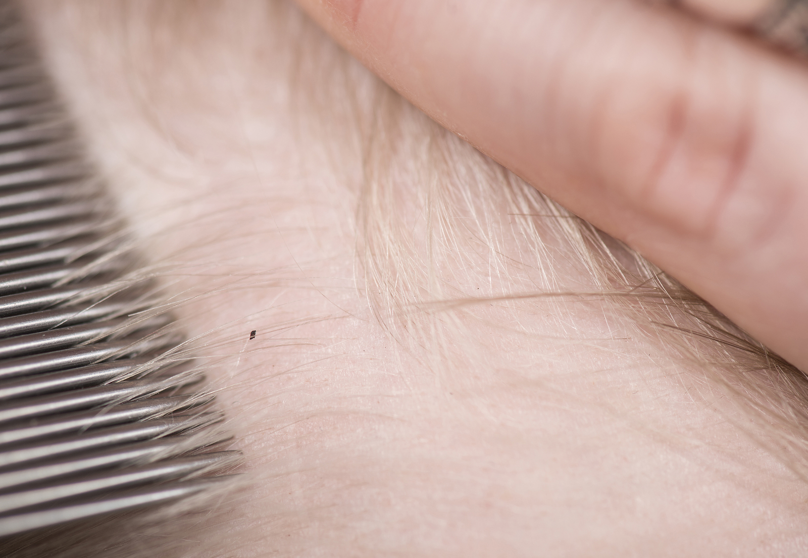 “Super lice” found in 25 states resistant to typical treatments